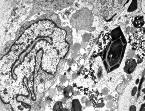 M,15y. | eosinophilic granuloma - Charcot- Leyden crystals M,15y. | eosinophilic granuloma - Charcot- Leyden crystals